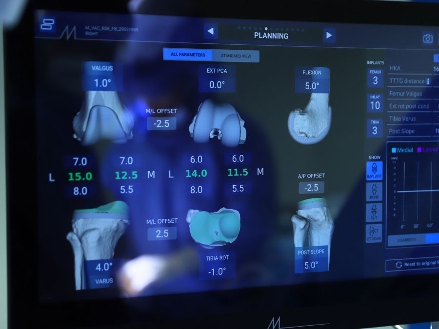 Animazione 3D che mostra il posizionamento di una protesi articolare